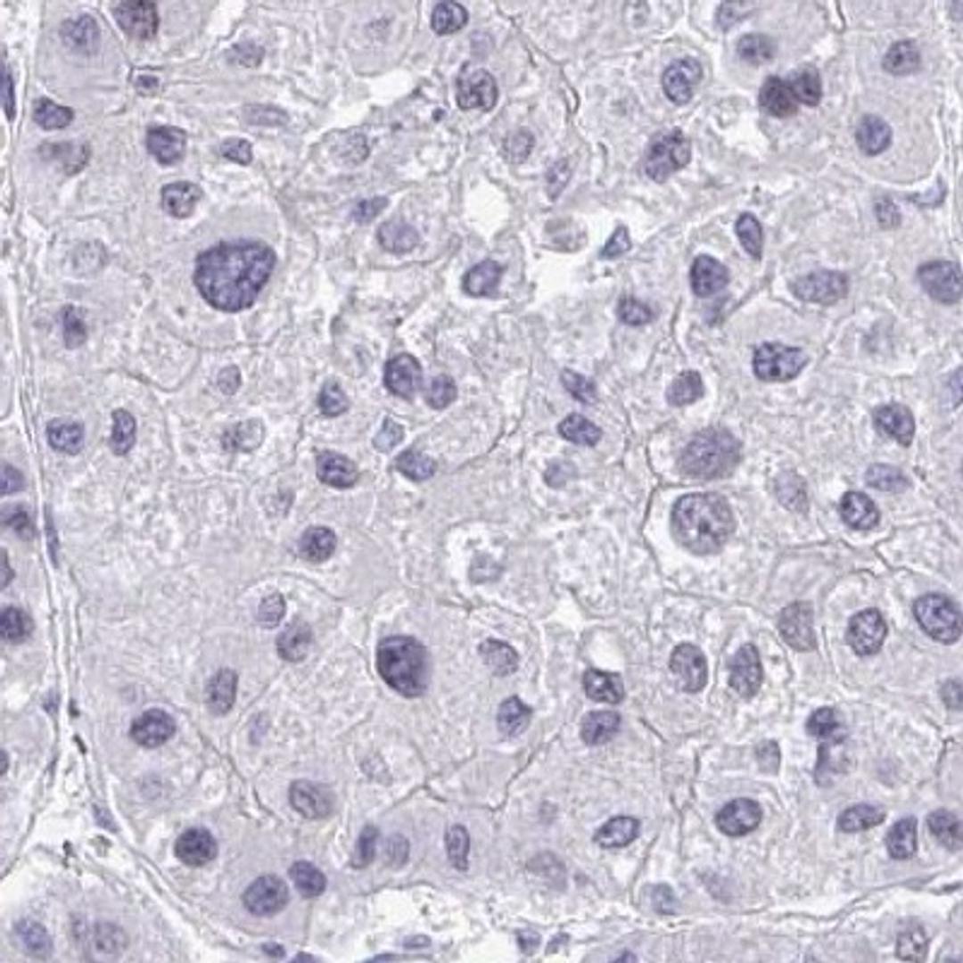 Immunohistochemistry: EID3 Antibody [NBP2-32455] - liver cancer