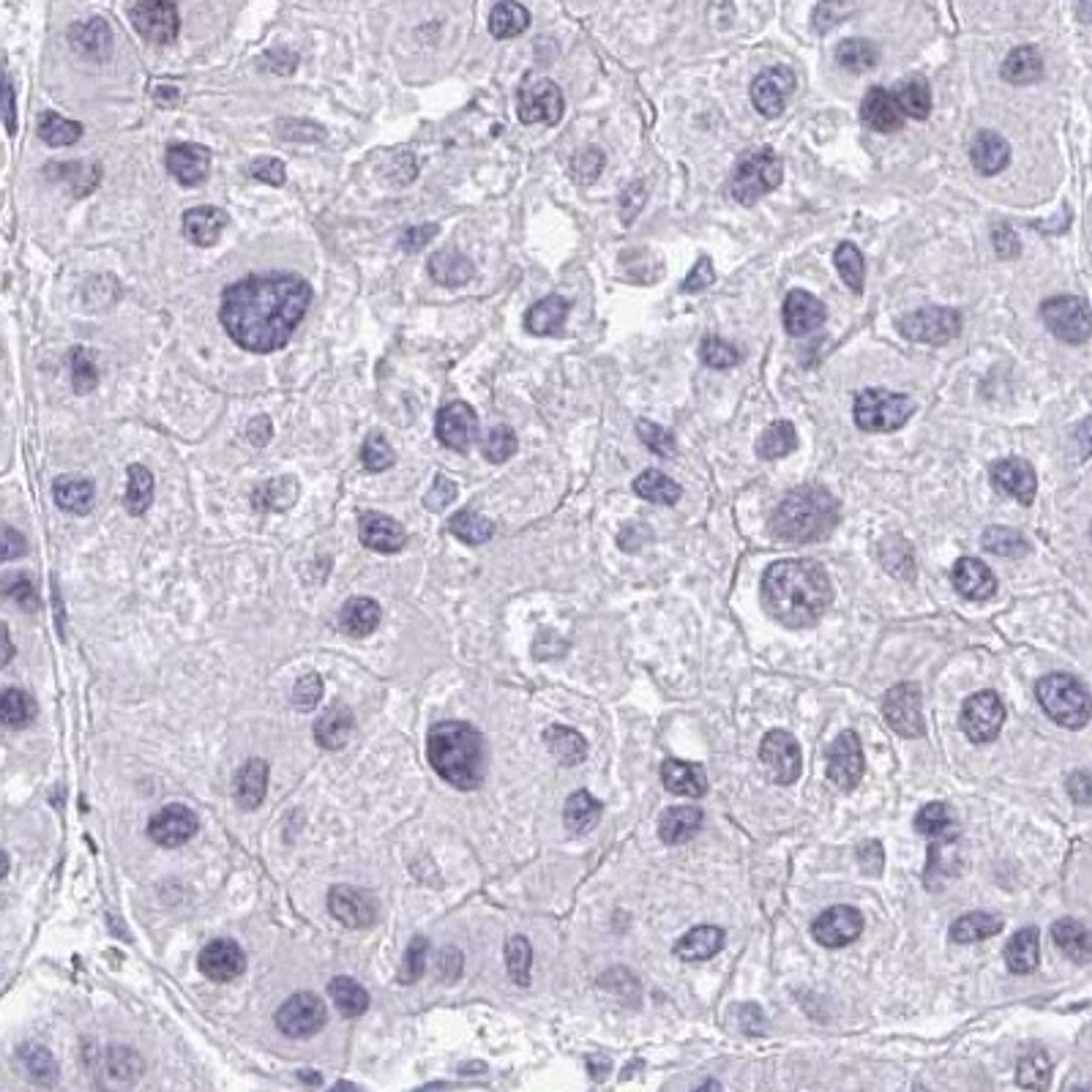 Immunohistochemistry: EID3 Antibody [NBP2-32455] - liver cancer