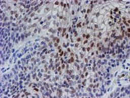 Immunohistochemistry-Paraffin: TDO2 Antibody (1D1) [NBP2-02002] - Staining of paraffin-embedded Carcinoma of Human bladder tissue using anti-TDO2 mouse monoclonal antibody.