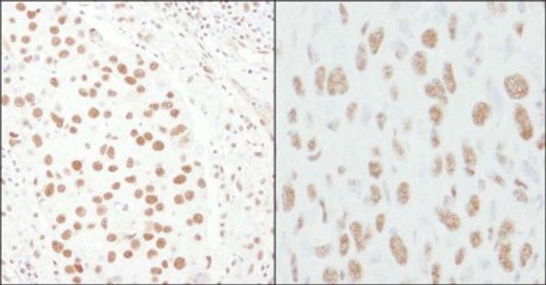 Immunohistochemistry-Paraffin: TCERG1 Antibody [NB300-214] - Human breast carcinoma (left) and mouse squamous cell carcinoma (right). Antibody used at a dilution of 1:1000 (1ug/ml).