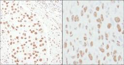 Immunohistochemistry-Paraffin: TCERG1 Antibody [NB300-214] - Human breast carcinoma (left) and mouse squamous cell carcinoma (right). Antibody used at a dilution of 1:1000 (1ug/ml).