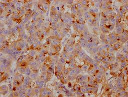 IHC image of CSB-RA449834A0HU diluted at 1:100 and staining in paraffin-embedded human breast cancer performed on a Leica BondTM system. After dewaxing and hydration, antigen retrieval was mediated by high pressure in a citrate buffer (pH 6.0). Section was blocked with 10% normal goat serum 30min at RT. Then primary antibody (1% BSA) was incubated at 4℃ overnight. The primary is detected by a Goat anti-rabbit IgG polymer labeled by HRP and visualized using 0.05% DAB.