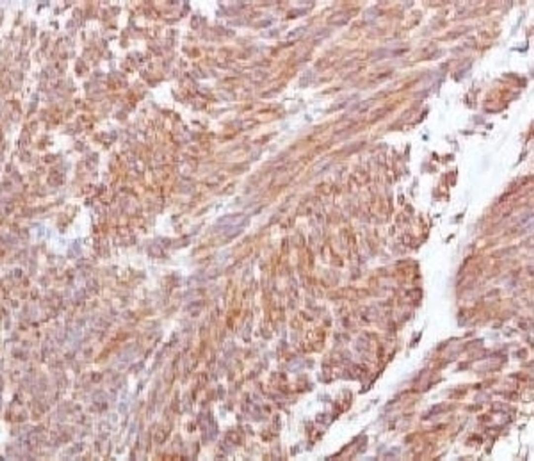 IHC testing of FFPE human gastrointestinal stromal tumor (GIST) and CD117 antibody (CLDA117).