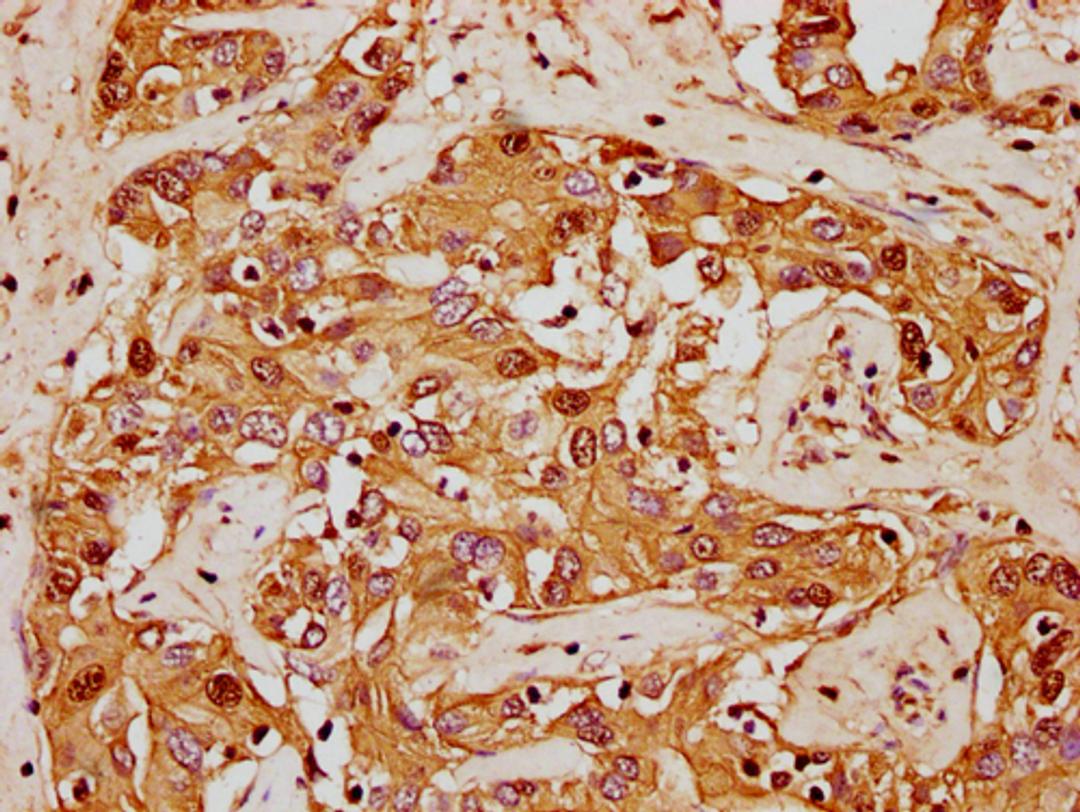 IHC image of CSB-PA010380OA62nforHU diluted at 1:20 and staining in paraffin-embedded human liver cancer performed on a Leica BondTM system. After dewaxing and hydration, antigen retrieval was mediated by high pressure in a citrate buffer (pH 6.0). Section was blocked with 10% normal goat serum 30min at RT. Then primary antibody (1% BSA) was incubated at 4°C overnight. The primary is detected by a biotinylated secondary antibody and visualized using an HRP conjugated SP system.
