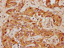 IHC image of CSB-PA010380OA62nforHU diluted at 1:20 and staining in paraffin-embedded human liver cancer performed on a Leica BondTM system. After dewaxing and hydration, antigen retrieval was mediated by high pressure in a citrate buffer (pH 6.0). Section was blocked with 10% normal goat serum 30min at RT. Then primary antibody (1% BSA) was incubated at 4°C overnight. The primary is detected by a biotinylated secondary antibody and visualized using an HRP conjugated SP system.