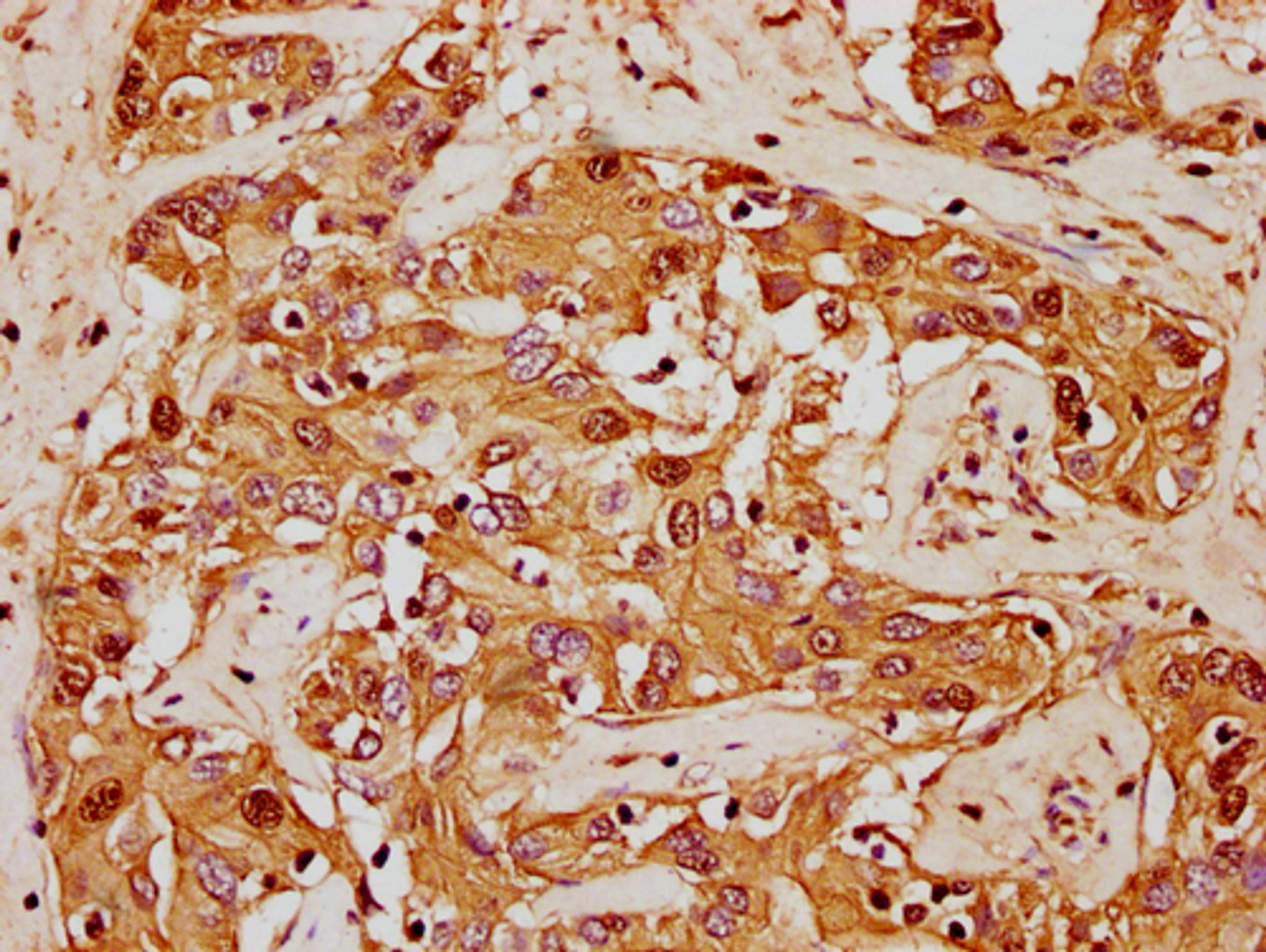 IHC image of CSB-PA010380OA62nforHU diluted at 1:20 and staining in paraffin-embedded human liver cancer performed on a Leica BondTM system. After dewaxing and hydration, antigen retrieval was mediated by high pressure in a citrate buffer (pH 6.0). Section was blocked with 10% normal goat serum 30min at RT. Then primary antibody (1% BSA) was incubated at 4°C overnight. The primary is detected by a biotinylated secondary antibody and visualized using an HRP conjugated SP system.