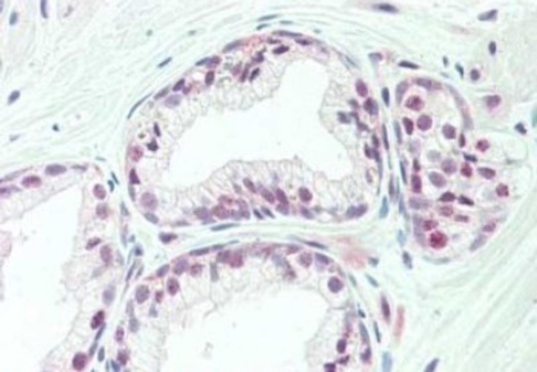 Immunohistochemistry: KAT4/TBP Associated Factor 1 Antibody [NBP1-77847] - Tissue: prostate. Fixation: formalin fixed paraffin embedded. Primary antibody: Anti-TAF1 at 10 ug/mL for 1 h at RT. Secondary antibody: Peroxidase rabbit secondary antibody at 1:10,000 for 45 min at RT. Staining: TAF-1 as precipitated red signal with hematoxylin purple nuclear counterstain.