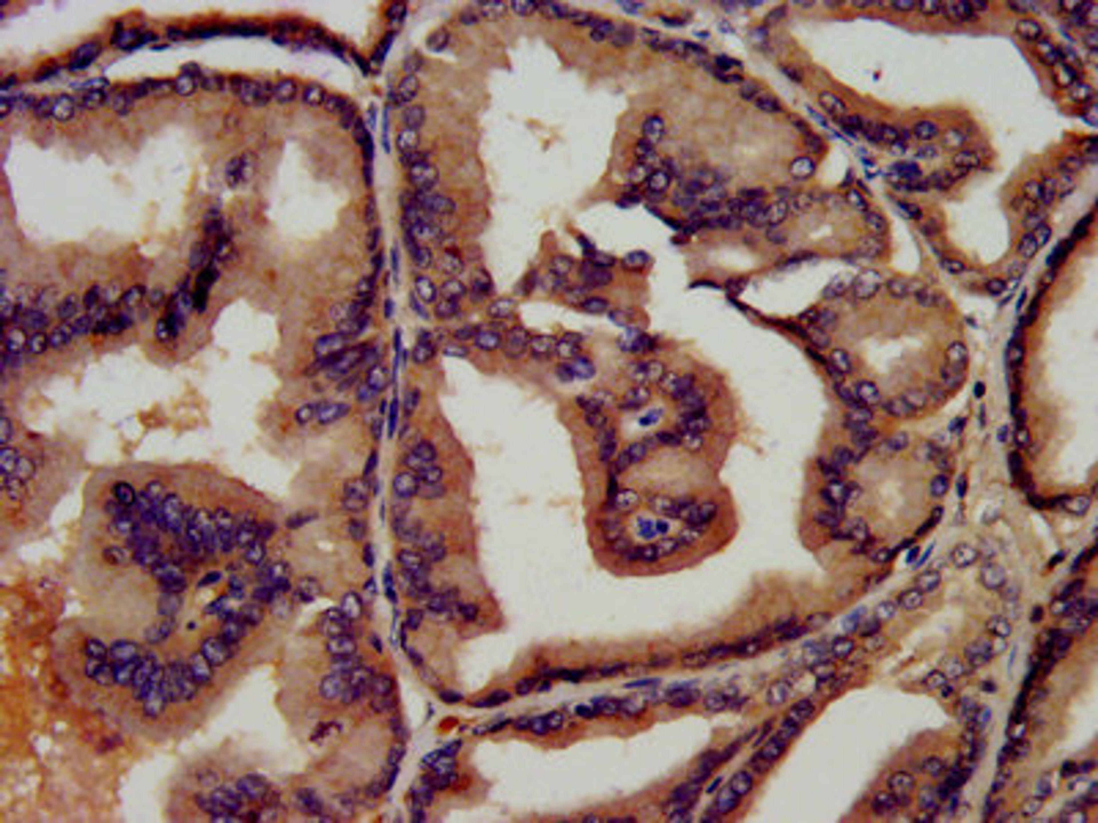 IHC image of CSB-PA00870E0Rb diluted at 1:450 and staining in paraffin-embedded human prostate tissue performed on a Leica BondTM system. After dewaxing and hydration, antigen retrieval was mediated by high pressure in a citrate buffer (pH 6.0). Section was blocked with 10% normal goat serum 30min at RT. Then primary antibody (1% BSA) was incubated at 4&deg;C overnight. The primary is detected by a biotinylated secondary antibody and visualized using an HRP conjugated SP system.