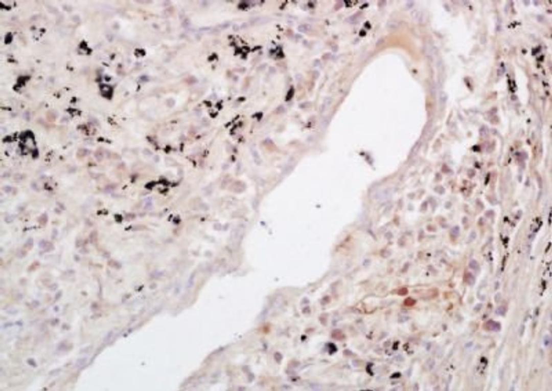 Immunohistochemical analysis of formalin-fixed paraffin embedded human lung carcinoma tissue using NFKB p52 antibody (dilution at 1:200)