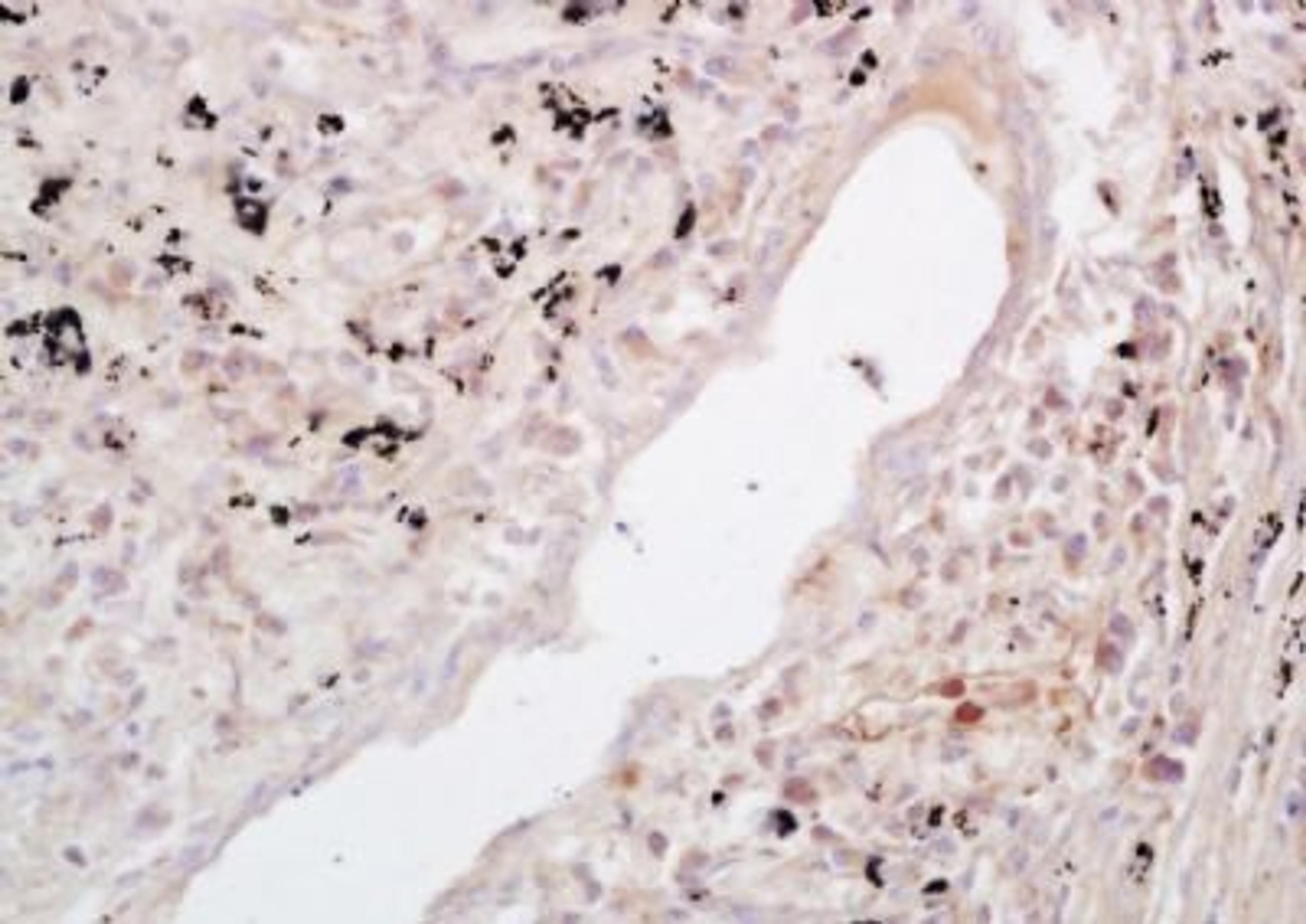 Immunohistochemical analysis of formalin-fixed paraffin embedded human lung carcinoma tissue using NFKB p52 antibody (dilution at 1:200)