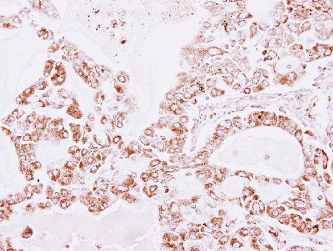 Immunohistochemistry-Paraffin: Peroxiredoxin 3 Antibody [NBP2-19777] - Immunohistochemical analysis of paraffin-embedded Lung AdC, using antibody at 1:100 dilution.