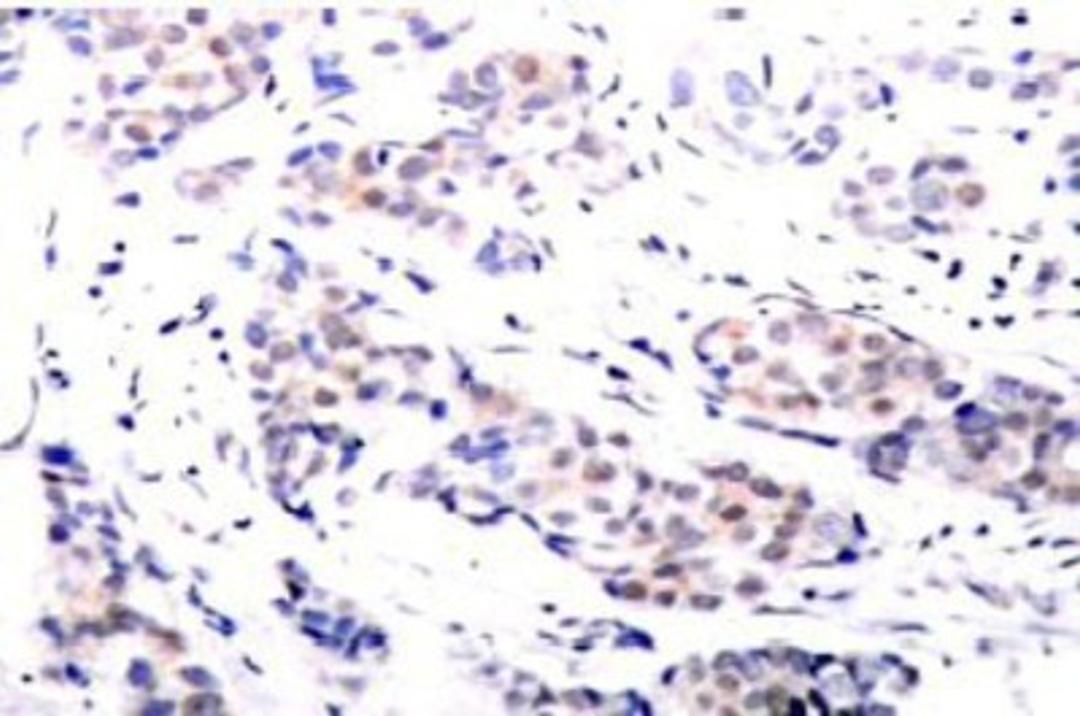 Immunohistochemistry: ELK1 Antibody [NB100-91747] - Human breast carcinoma tissue