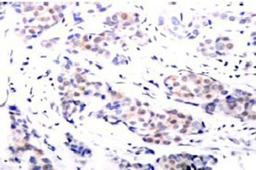 Immunohistochemistry: ELK1 Antibody [NB100-91747] - Human breast carcinoma tissue