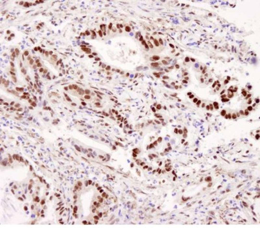 Immunohistochemistry-Paraffin: CARM1 Antibody [NB200-342] - Human stomach carcinoma. Antibody used at a dilution of 1:5,000 (0.2ug/ml).