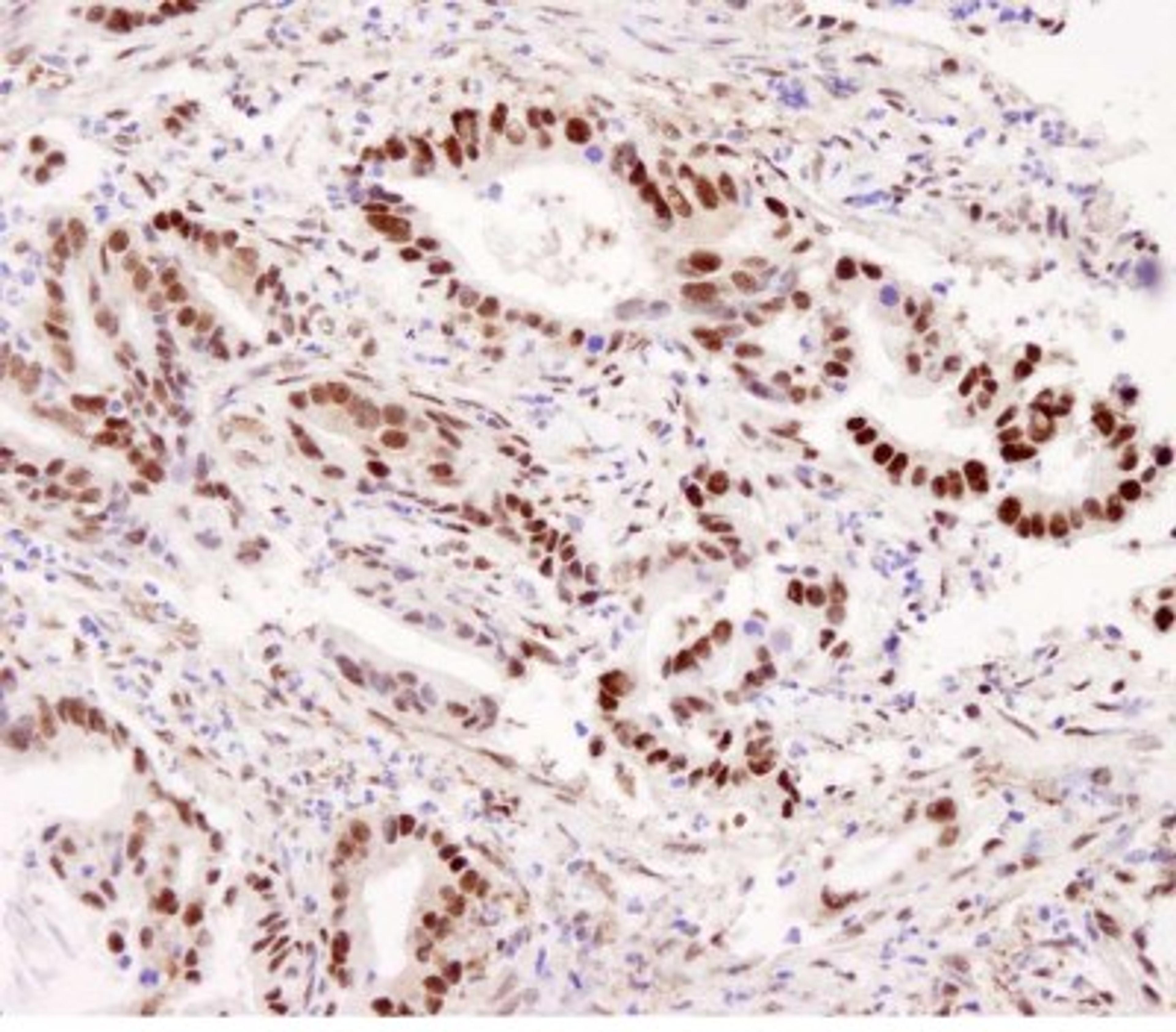 Immunohistochemistry-Paraffin: CARM1 Antibody [NB200-342] - Human stomach carcinoma. Antibody used at a dilution of 1:5,000 (0.2ug/ml).