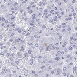 Immunohistochemistry: Cdx4 Antibody [NBP2-31643] - liver cancer