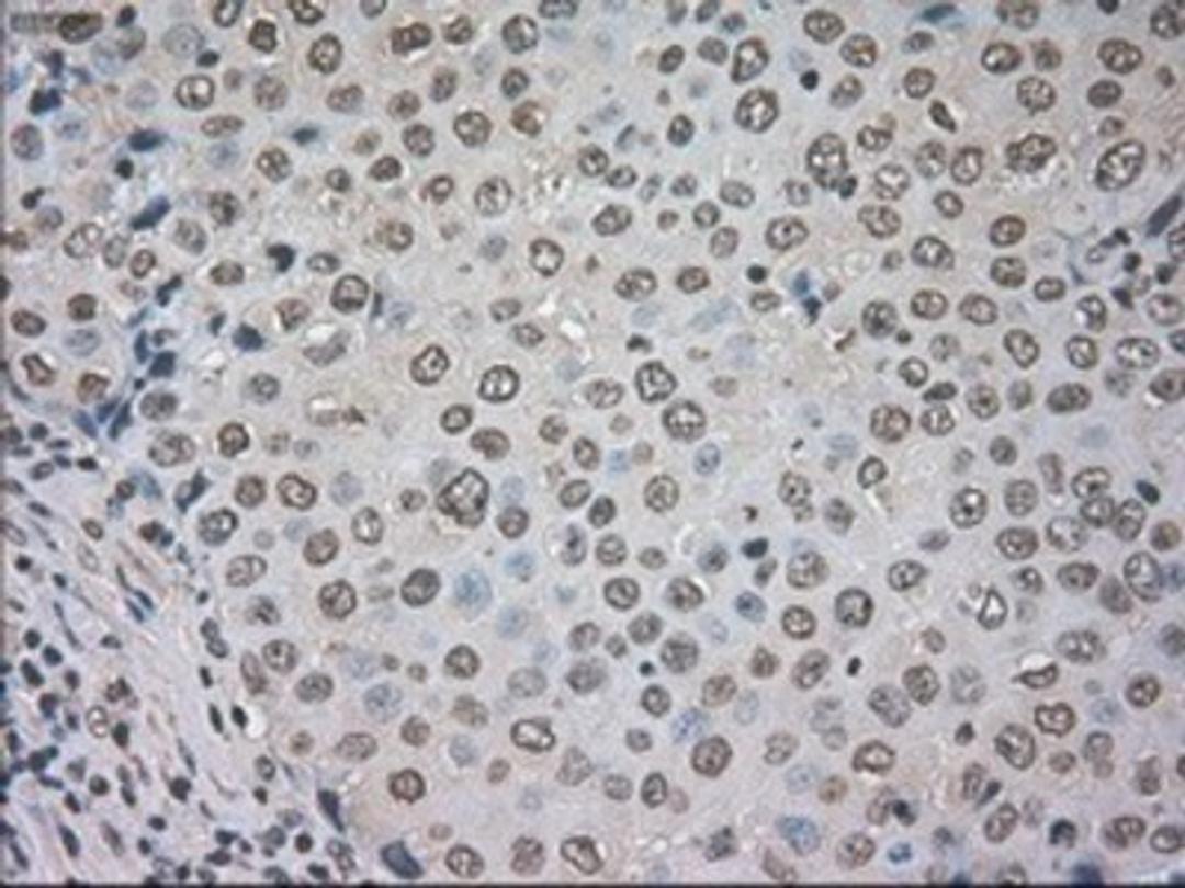 Immunohistochemistry-Paraffin: CTAG1B Antibody (2B6) [NBP1-47714] - Staining of paraffin-embedded Adenocarcinoma of breast tissue using anti-CTAG1B mouse monoclonal antibody.