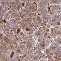 Immunohistochemistry: FBXL13 Antibody [NBP2-31664] - liver cancer