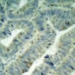 Immunohistochemistry: Src [p Tyr418] Antibody [NB100-92633] - Analyzes of p-Src  (Y418) antibody in paraffin-embedded human colon  carcinoma tissue.