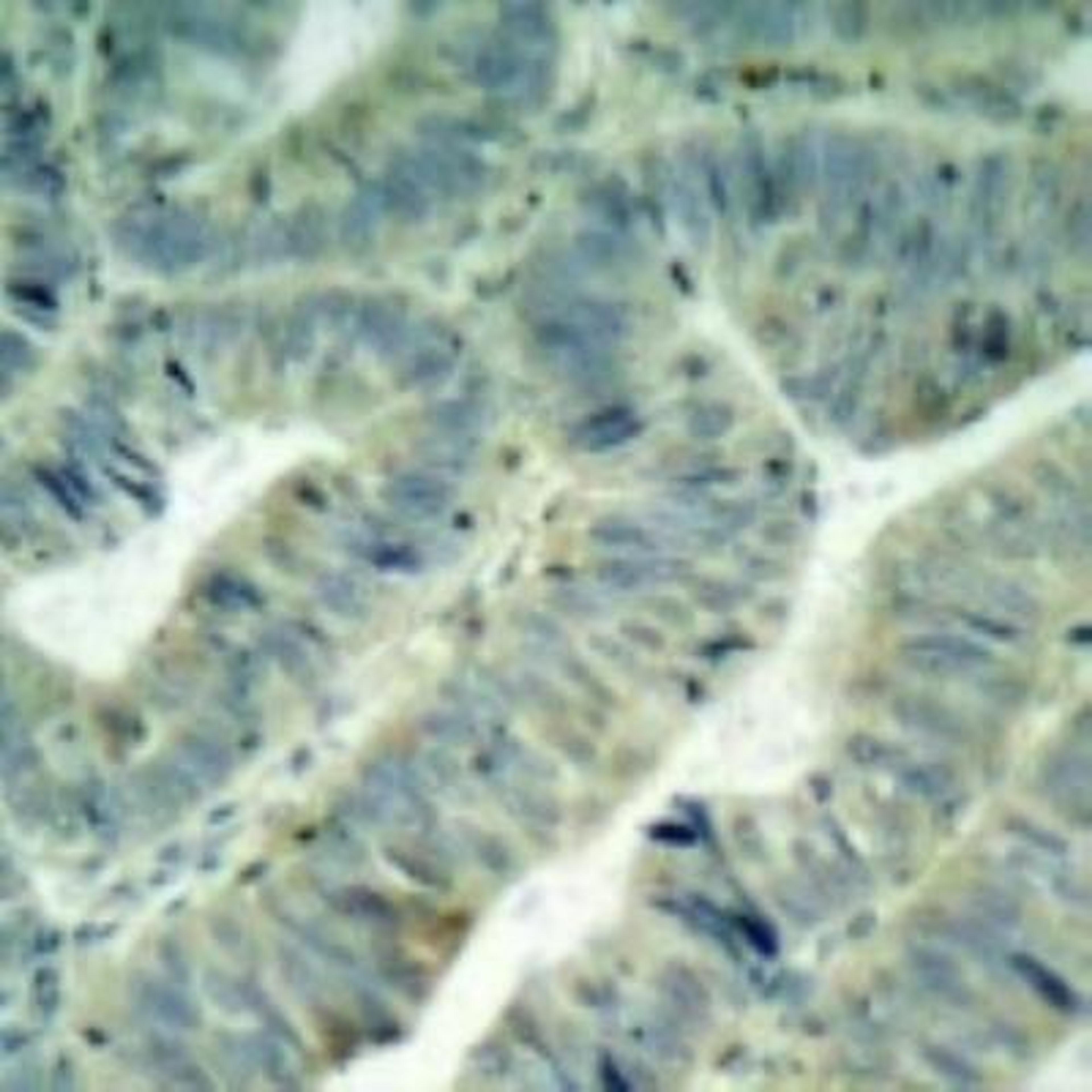 Immunohistochemistry: Src [p Tyr418] Antibody [NB100-92633] - Analyzes of p-Src  (Y418) antibody in paraffin-embedded human colon  carcinoma tissue.