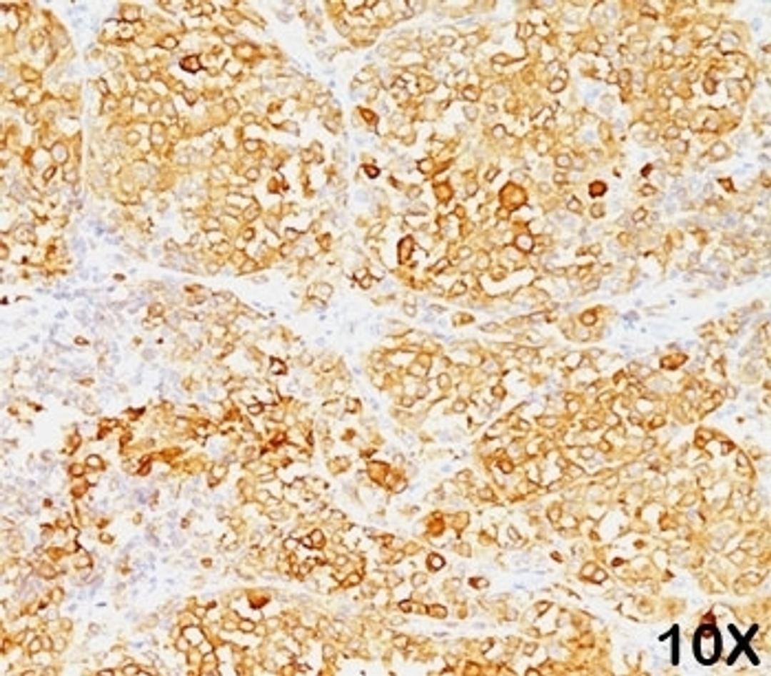 Formalin/paraffin human melanoma stained with MART-1 / Melan-A antibody (M2-9E3). Note cytoplasmic staining of cells.