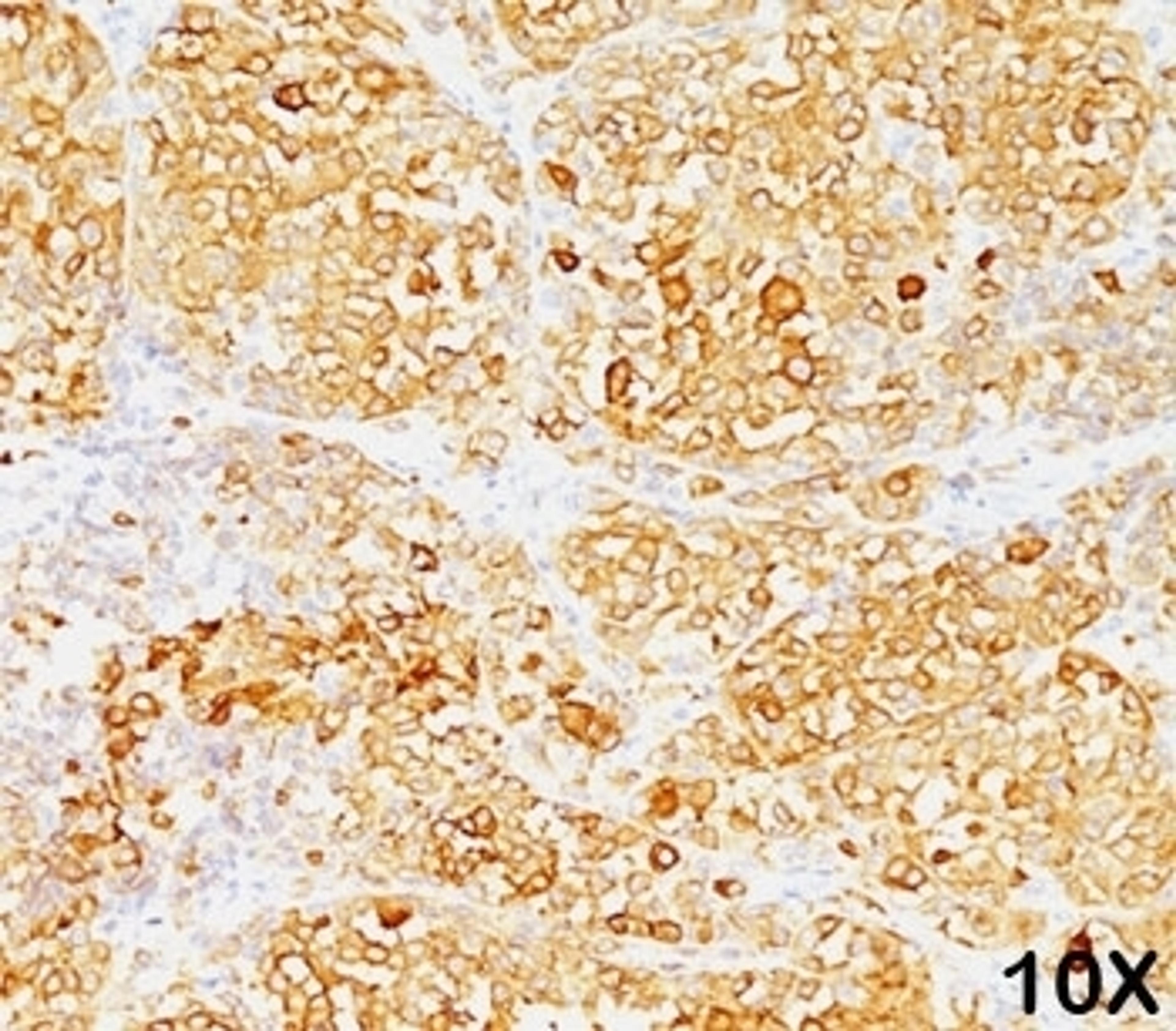 Formalin/paraffin human melanoma stained with MART-1 / Melan-A antibody (M2-9E3). Note cytoplasmic staining of cells.