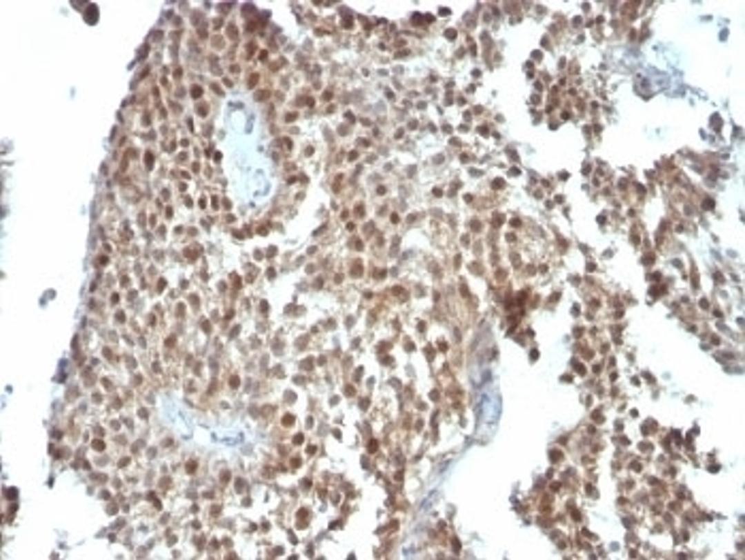 Formalin-fixed, paraffin-embedded human colon carcinoma stained with anti-p21 antibody (SPM306).