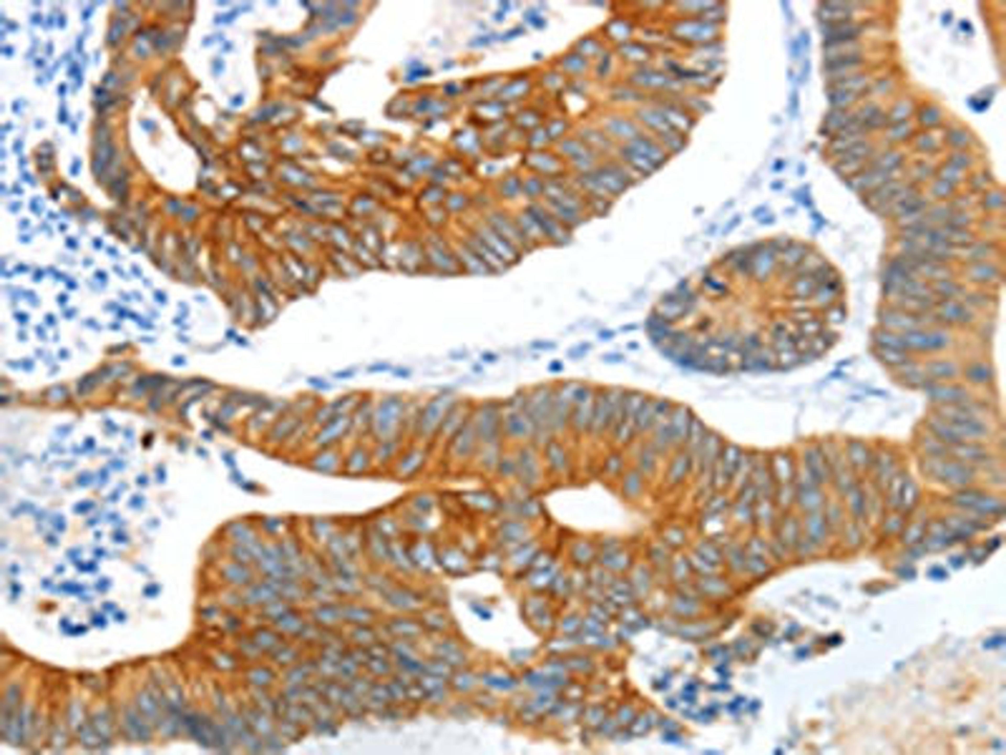 The image on the left is immunohistochemistry of paraffin-embedded Human colon cancer tissue using CSB-PA443781(KRT2 Antibody) at dilution 1/20, on the right is treated with fusion protein. (Original magnification: ×200)