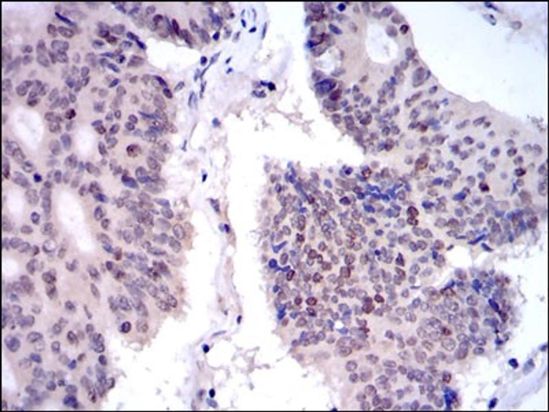 Immunohistochemistry: KIF22 Antibody (1E3) [NBP2-37550] - Immunohistochemical analysis of paraffin-embedded colon cancer tissues using KID mouse mAb with DAB staining.