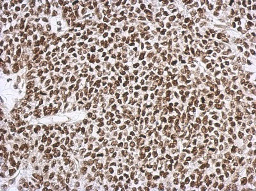 Immunohistochemistry-Paraffin: SNIP1 Antibody [NBP2-20437] - Immunohistochemical analysis of paraffin-embedded 59T xenograft, using antibody at 1:500 dilution.