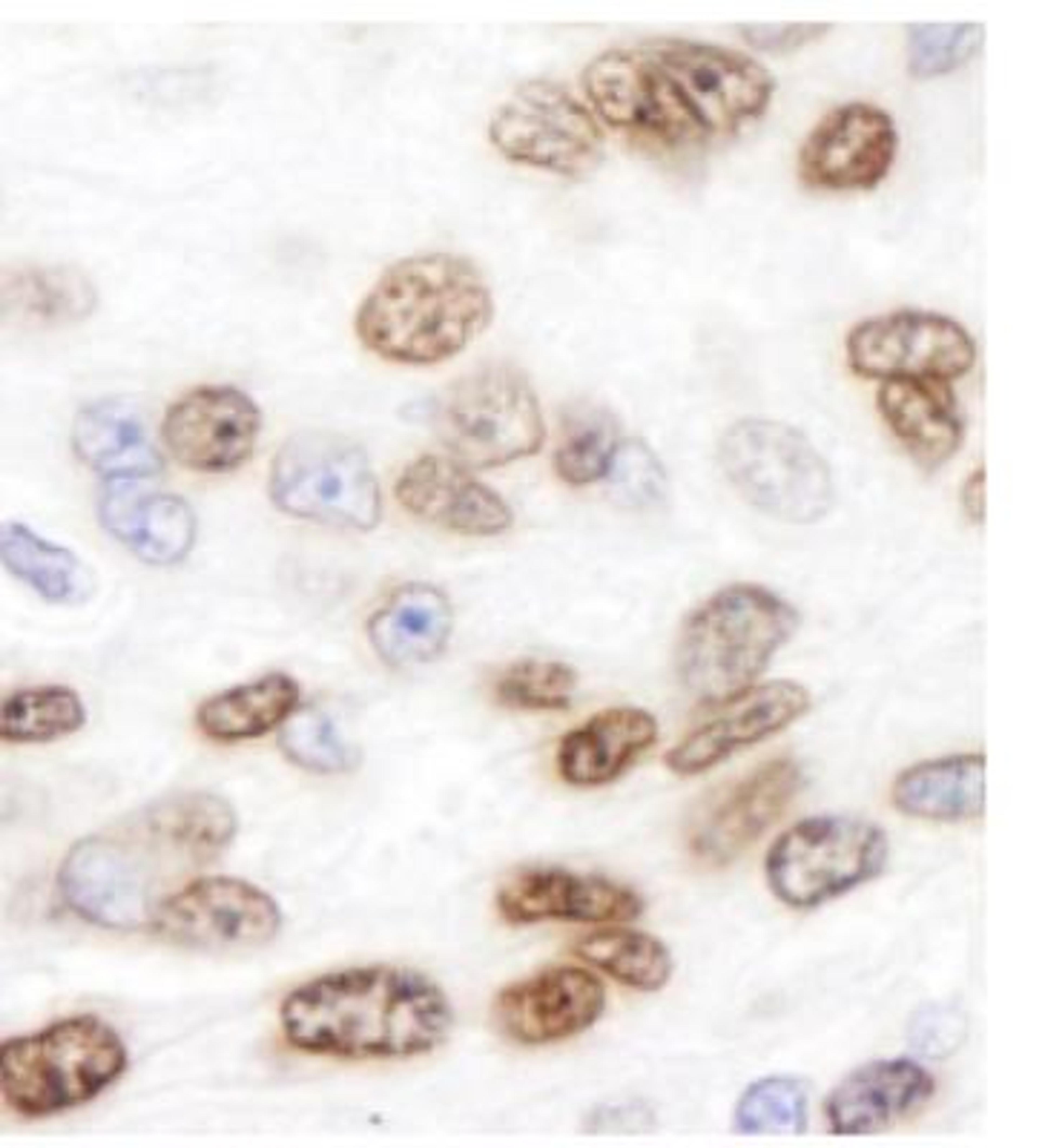 Immunohistochemistry-Paraffin: H2AX Antibody [NB100-383] - Section of human ovarian carcinoma.