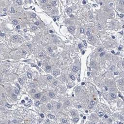 Immunohistochemistry: TMEM182 Antibody [NBP2-32038] - liver cancer