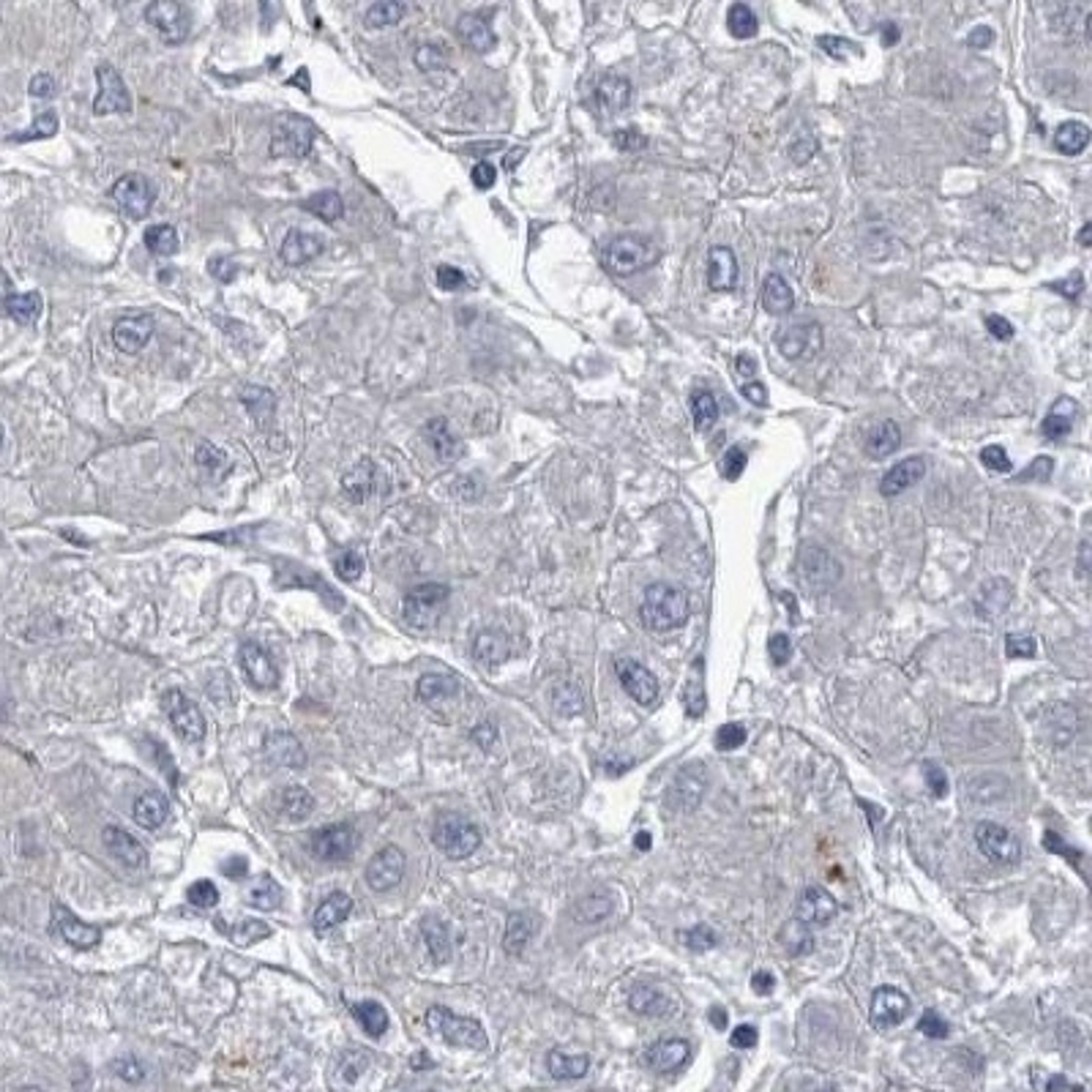 Immunohistochemistry: TMEM182 Antibody [NBP2-32038] - liver cancer