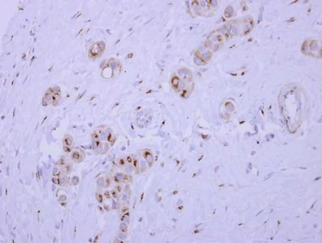 Immunohistochemistry-Paraffin: SYAP1 Antibody [NBP2-20541] - SYAP1 antibody detects SYAP1 protein at cytoplasm on Breast carcinoma by immunohistochemical analysis. Sample: Paraffin-embedded Breast carcinoma. SYAP1 antibody dilution: 1:500.