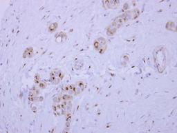 Immunohistochemistry-Paraffin: SYAP1 Antibody [NBP2-20541] - SYAP1 antibody detects SYAP1 protein at cytoplasm on Breast carcinoma by immunohistochemical analysis. Sample: Paraffin-embedded Breast carcinoma. SYAP1 antibody dilution: 1:500.