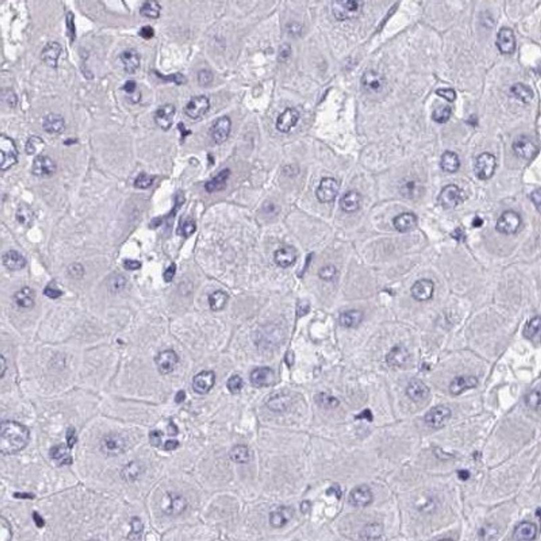 Immunohistochemistry: OXLD1 Antibody [NBP2-31653] - liver cancer