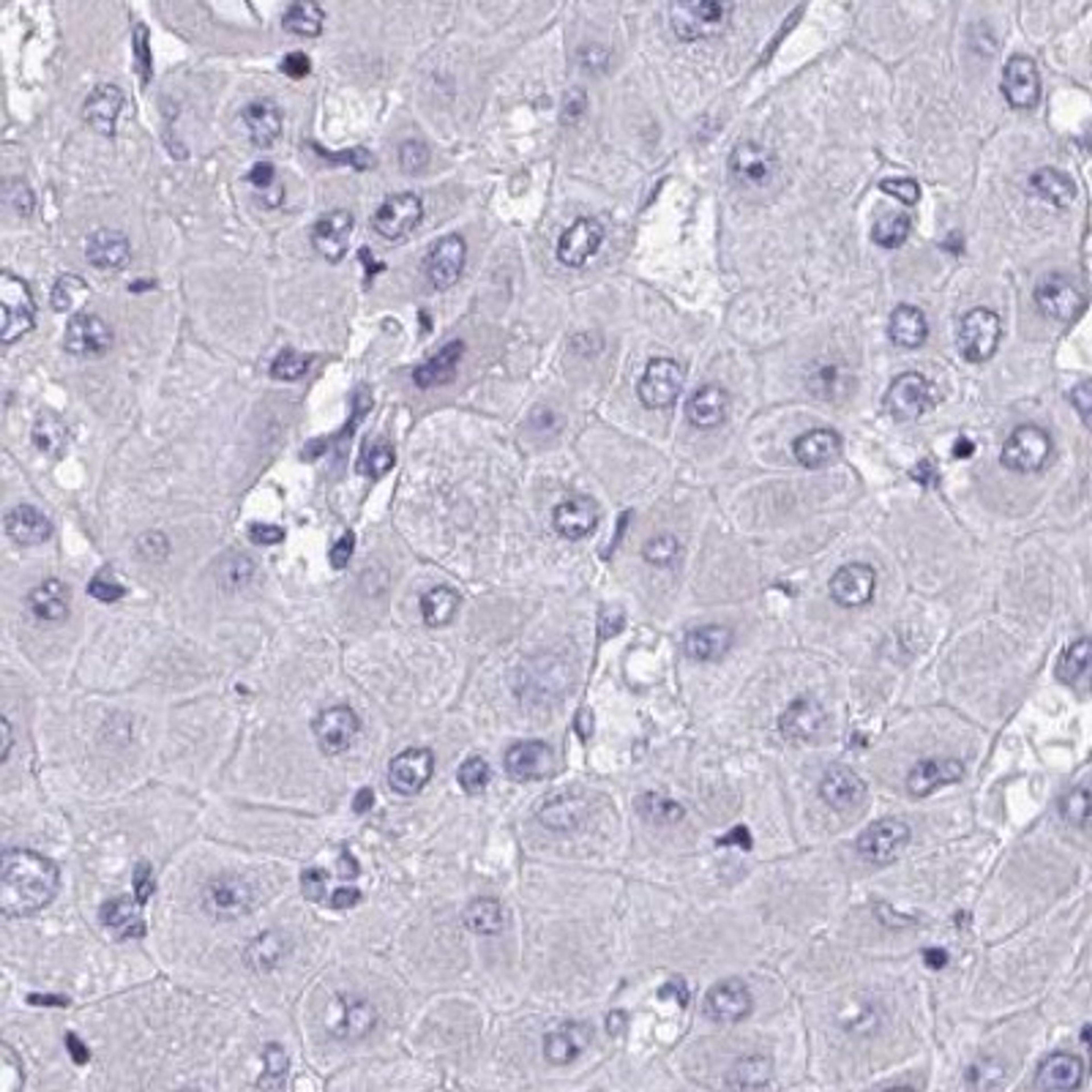 Immunohistochemistry: OXLD1 Antibody [NBP2-31653] - liver cancer