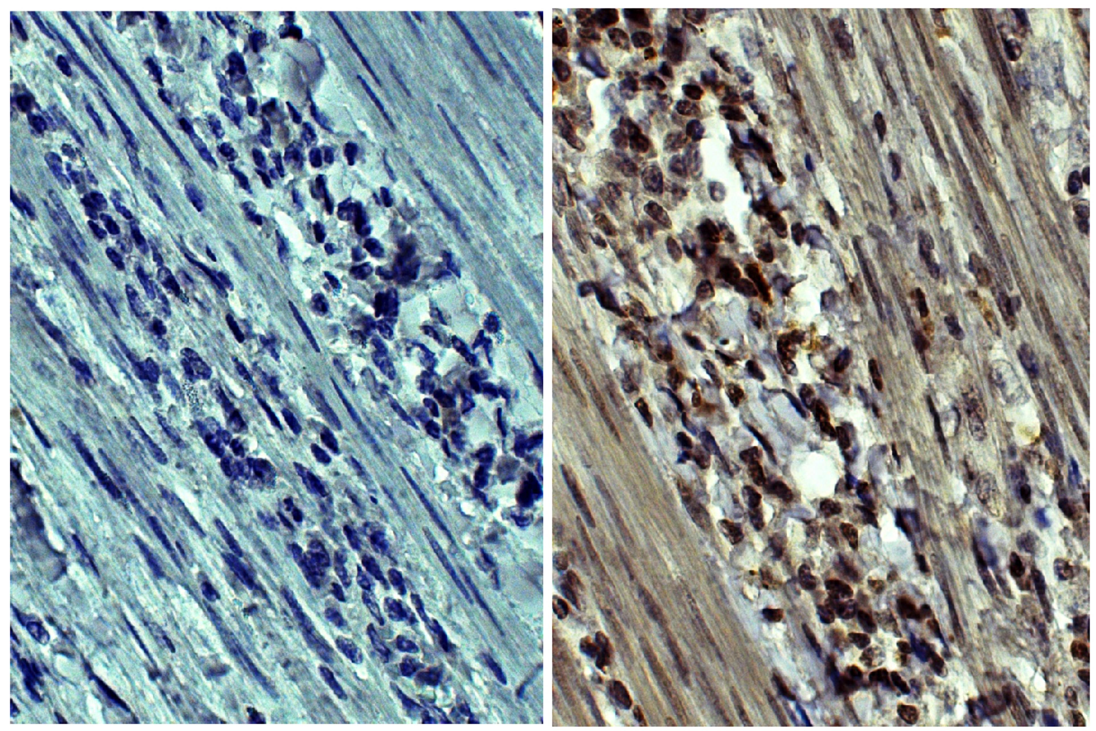 Human gastric cancer tissue was stained with Mouse IgG2a-HRP (Isotype Control; Cat. No. 0103-05) or Mouse Anti-Human MMP-9-HRP (Cat. No. 99-774).