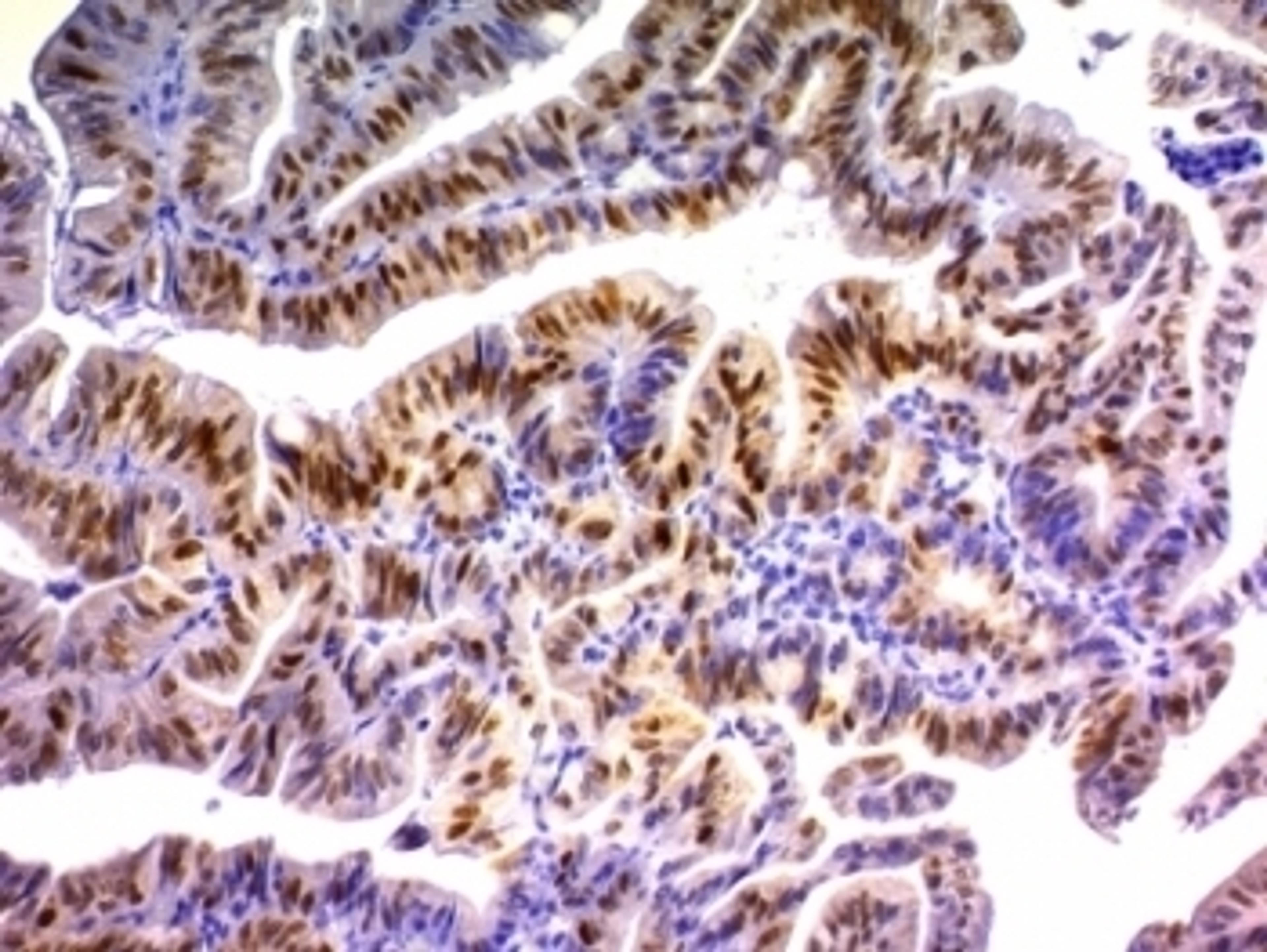 Formalin-fixed, paraffin-embedded human colon carcinoma stained with p21 antibody (DCS-60.2).