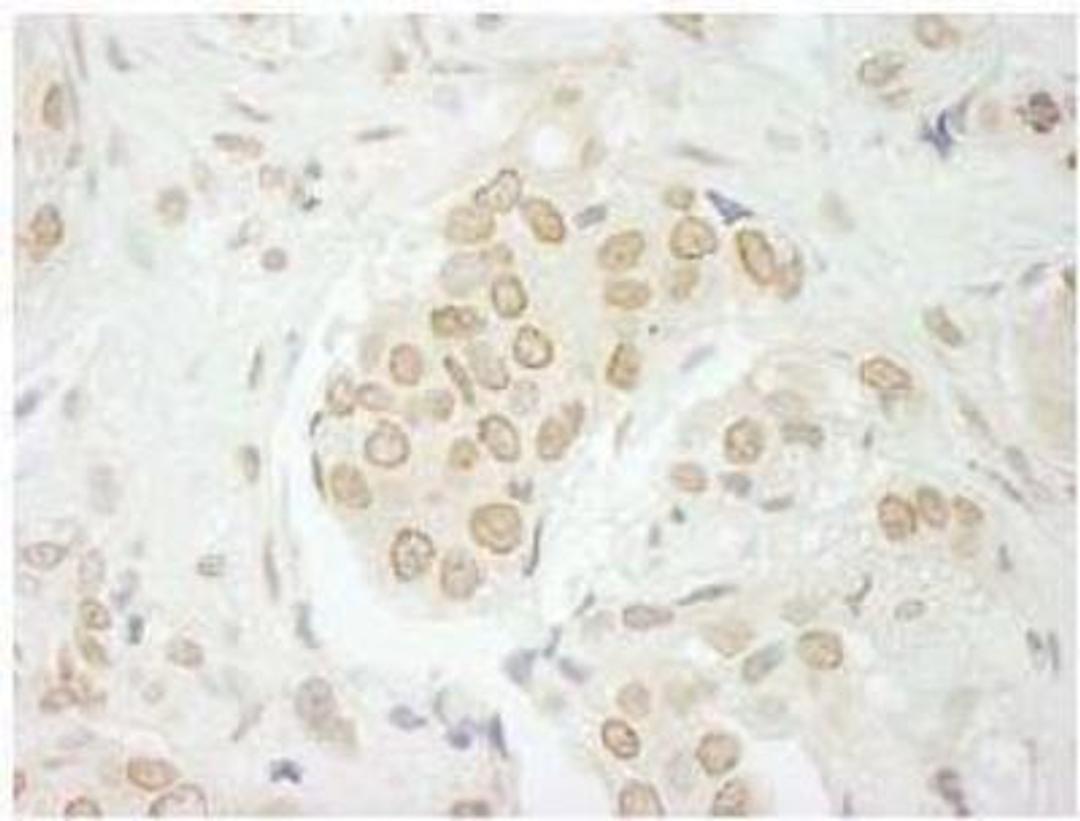 Immunohistochemistry-Paraffin: USP33 Antibody [NB110-40693] - FFPE section of human breast carcinoma.  Affinity purified rabbit anti-USP33 used at a dilution of 1:250.