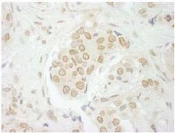 Immunohistochemistry-Paraffin: USP33 Antibody [NB110-40693] - FFPE section of human breast carcinoma.  Affinity purified rabbit anti-USP33 used at a dilution of 1:250.