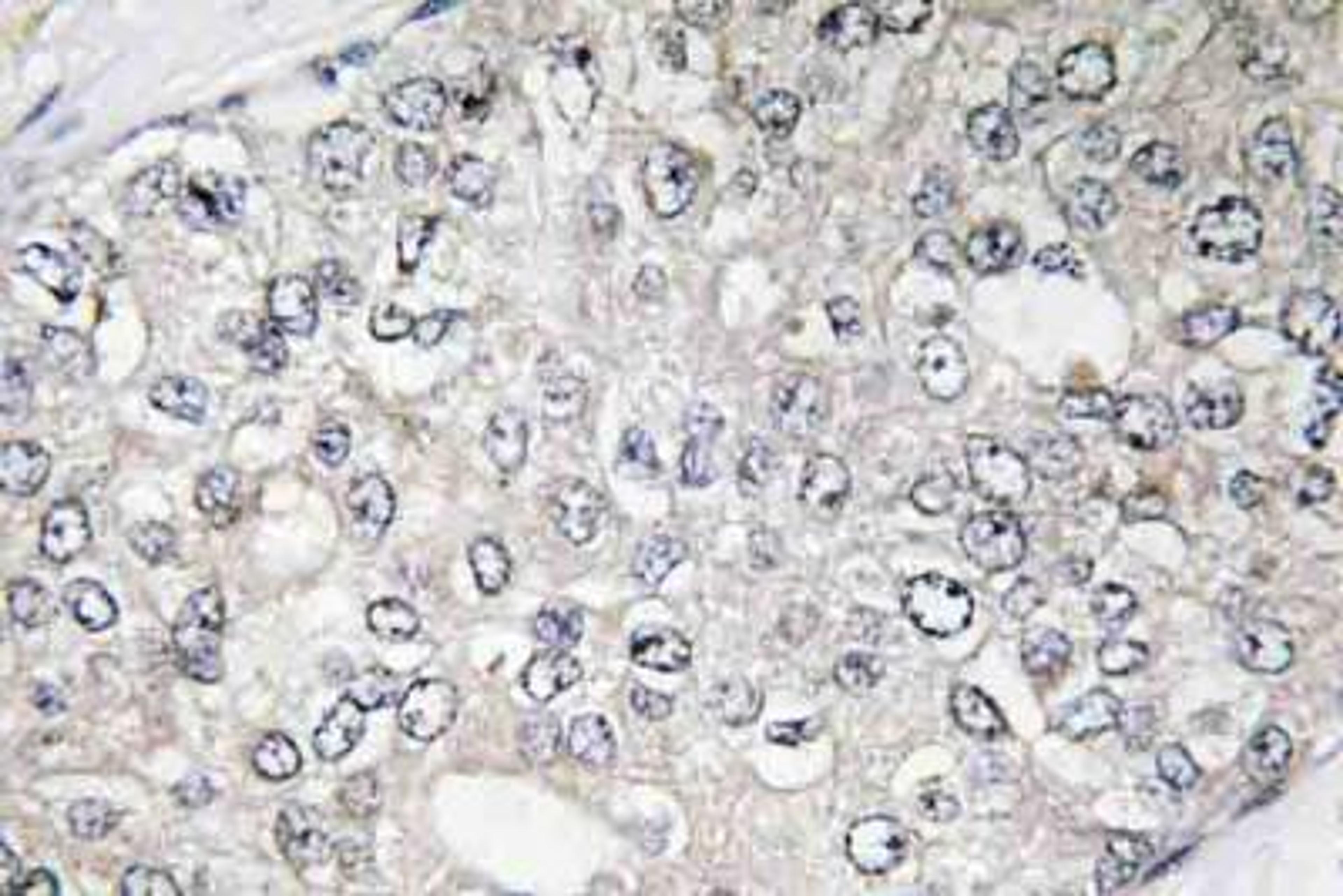 Immunohistochemistry-Paraffin: S6K [p Thr444] Antibody [NBP1-51460] -  analyzes of p-p70 S6 kinase Alpha  (T444) pAb in paraffin-embedded human breast carcinoma tissue.