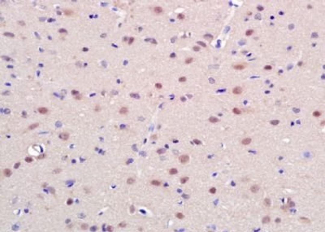 Immunohistochemical analysis of formalin-fixed paraffin embedded Human lung cancer tissue using CAMTA1 antibody (dilution at 1:200)