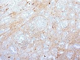 Formalin-fixed, paraffin-embedded human pancreatic adenocarcinoma stained with Fibronectin antibody (SPM539).