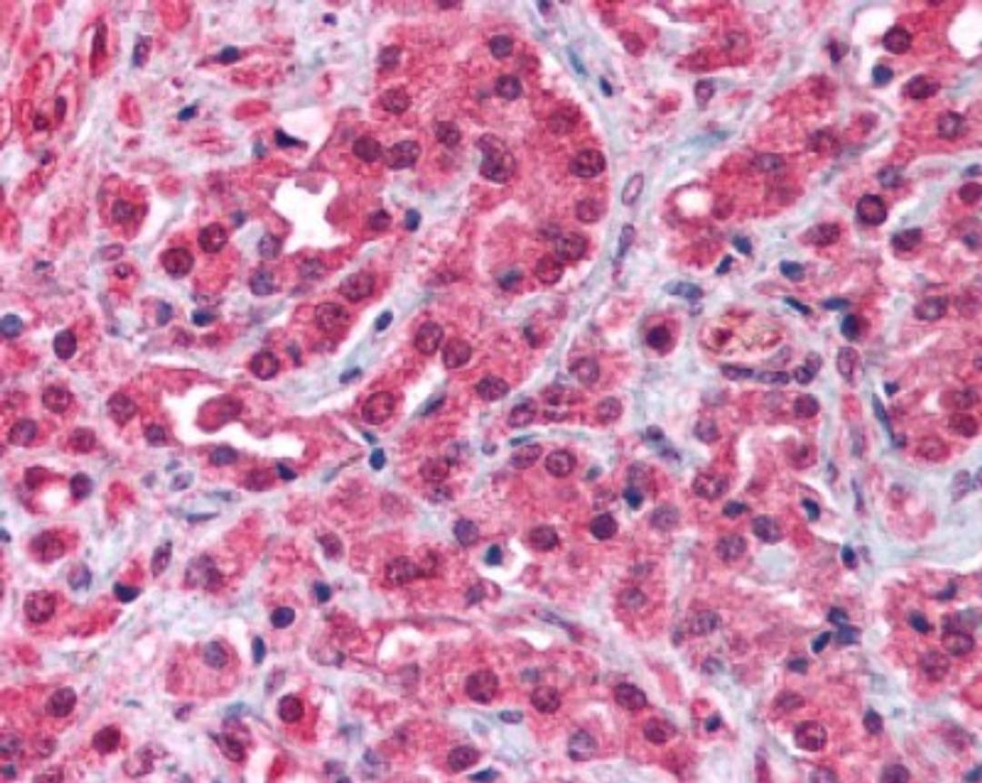 Immunohistochemistry: TRPM8 Antibody [NB200-145] - Prostate cancer: Formalin-Fixed Paraffin-Embedded (FFPE)