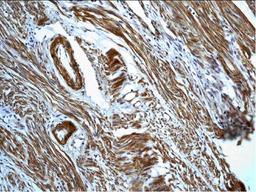 Immunohistochemical analysis of formalin-fixed paraffin embedded human endometrial carcinoma using Calretinin antibody