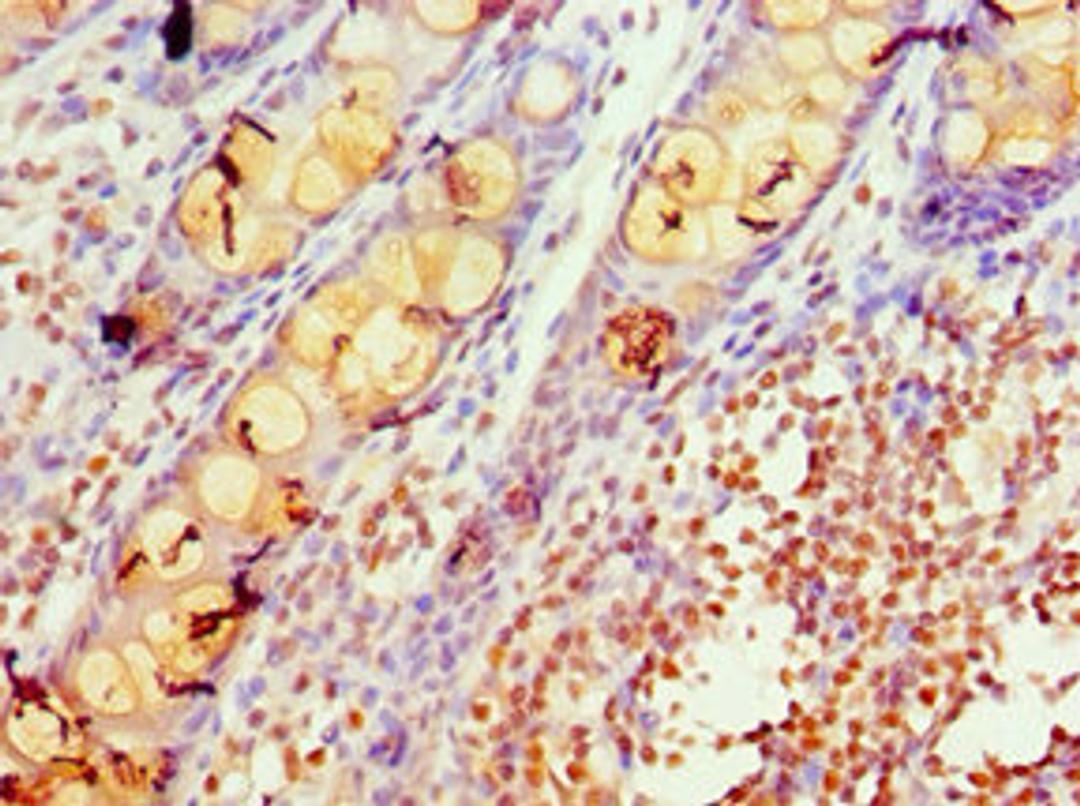 Immunohistochemistry of paraffin-embedded human colon tissue using CSB-PA012086ESR1HU at dilution of 1:100
