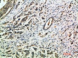 Immunohistochemical analysis of paraffin-embedded human-breast-cancer, antibody was diluted at 1:200