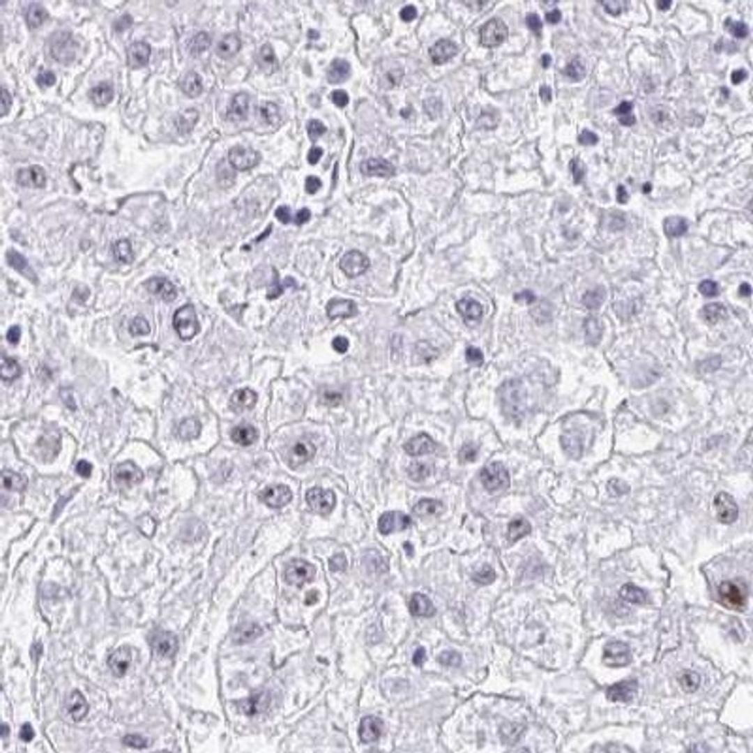 Immunohistochemistry: NOP10 Antibody [NBP2-32441] - liver cancer