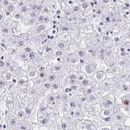 Immunohistochemistry: NOP10 Antibody [NBP2-32441] - liver cancer